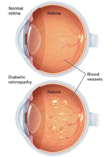 normal vs diabetic retina
