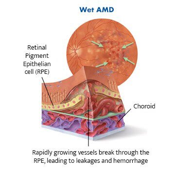 Diagram-of-wet-AMD